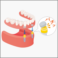 インプラントオーバーデンチャー
